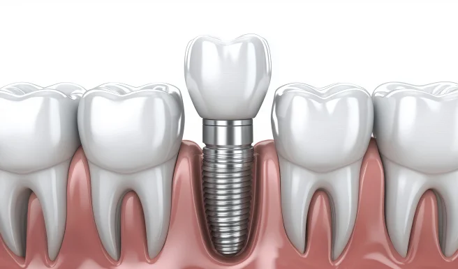 Dental Implant Diagram