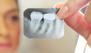 x-ray of a tooth with a needed root canal at Advanced Dental Concepts of Oakland